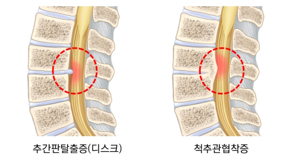 디스크 VS 협착증_600.jpg