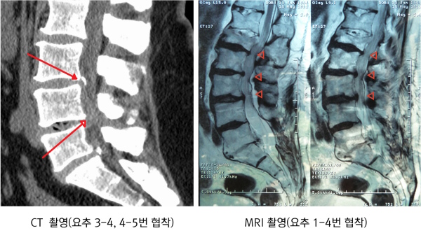 CT&MRI 척추협착_600.jpg